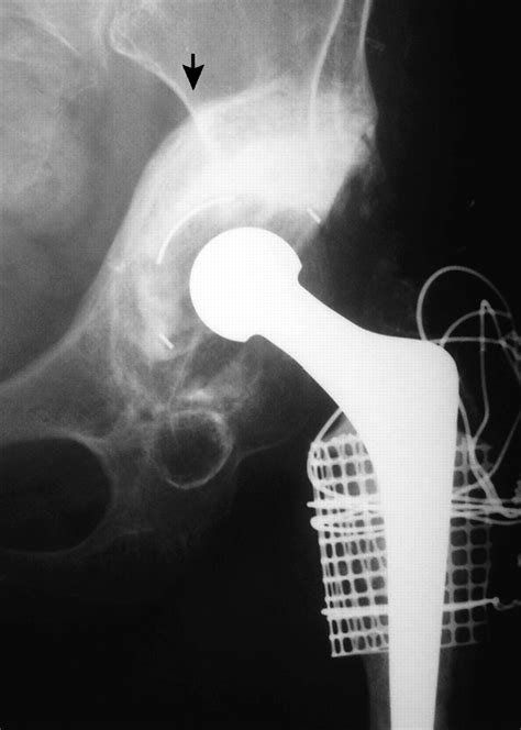 Acetabular Reconstruction With Impacted Bone Allografts And Cemented Acetabular Components