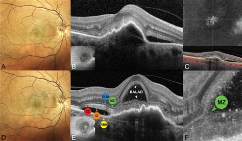 Bacillary Layer Detachment Associated With Exudative Neovascular Amd