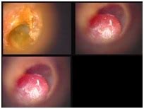 Tumori Glomici O Paraganglioma TimpanogiuguIare O Chemodectoma