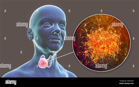 Thyroid Gland Cancer Illustration Stock Photo Alamy