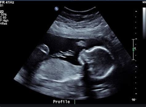 3d And 4d Pregnancy Ultrasound What To Expect