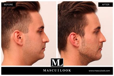 Tratamiento Masculinización Clínica Estética Castelblanque Jávea