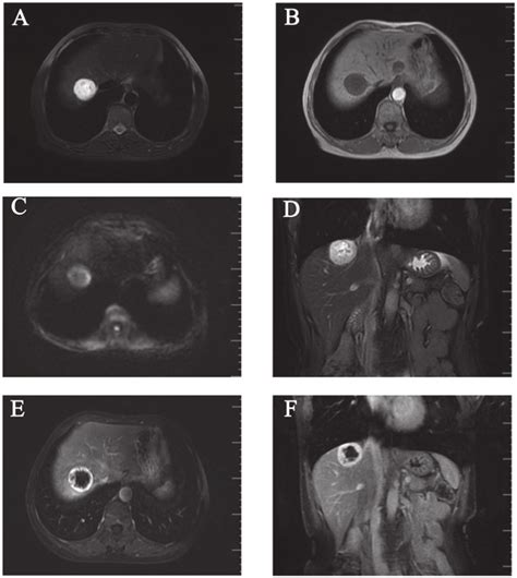 Contrast Enhanced Magnetic Resonance Imaging Scan A Round