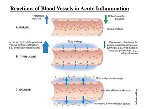 Ppt General Pathology Chapter Acute And Chronic Inflammation