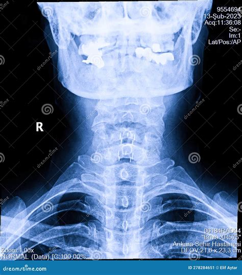 Human Cervical Spine X-ray, Neck Radiography Stock Image - Image of