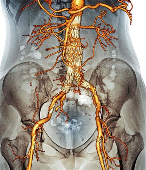 Stent In Aortic Aneurysm Photograph By Zephyrscience Photo Library Fine Art America