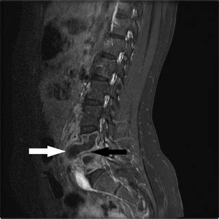 Magnetic Resonance Image Showing Acute Discitis Osteomyelitis At