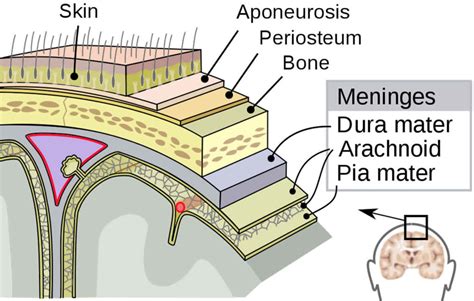 Epidural Hematoma Causes Signs Symptoms Diagnosis And Treatment