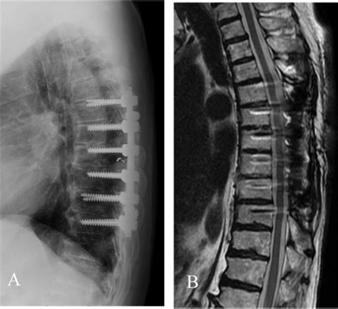 A Preoperative Angiogram Showing That The Tumor Was Fed By The Left