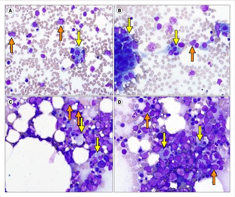 Figure 1 From A Rare Case Of Diffuse Large B Cell Lymphoma Associated