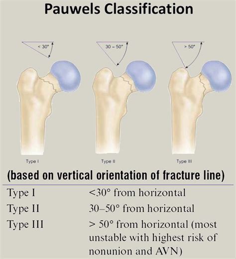 Overview Of Classification And Surgical Management Of Hip Fractures