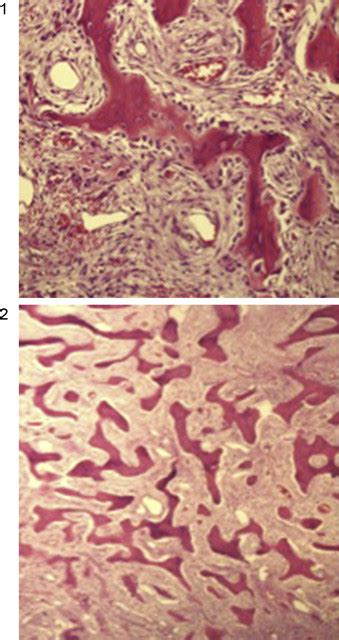 A Y B Imágenes Histológicas Del Fibroma Osificante Download Scientific Diagram