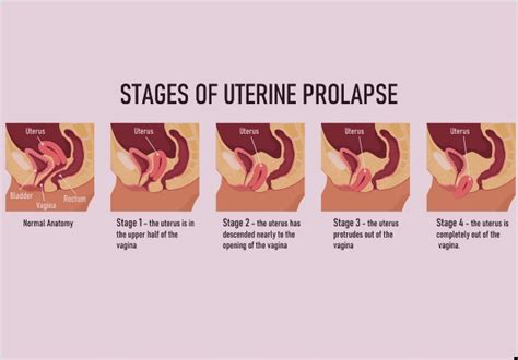 The Major Types Of Pelvic Organ Prolapse And Their Differences Vaginal