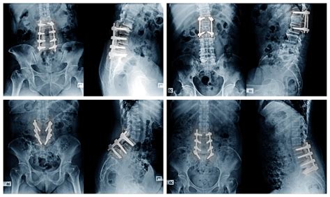 Lumbar Fusion Everything You Need To Know William Capicotto M D Pc