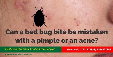 Can A Bed Bug Bite Be Mistaken With A Pimple Or An Acne