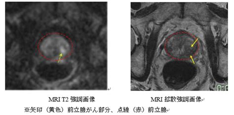 前立腺がん｜がん診療の特色と実績（院内がん登録）｜診療体制｜久留米大学病院