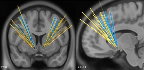 Localization Of Individual Leads All Patients Underwent Dbs Surgery To