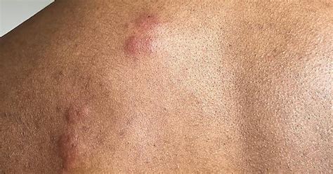 Hives On Left Shoulder And Neck Album On Imgur