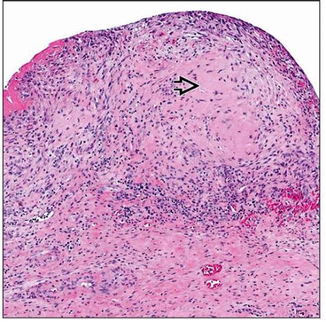 Acute Rheumatic Fever Subcutaneous Nodules