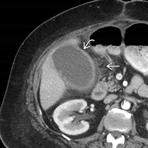 Acalculous Cholecystitis Clinical Gate