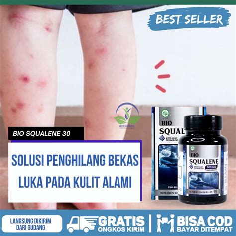 Jual Obat Penghilang Bekas Luka Koreng Hitam Menahun Cara