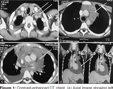 Figure 1 From A Rare Case Of Isoniazid Mono Resistant Tuberculosis Presenting As Cardiac