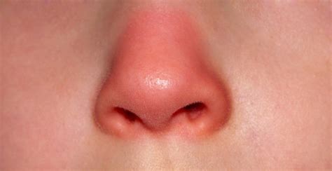 What Are The Signs Of A Red Swollen Nose And Loss Of Smell Vinmec