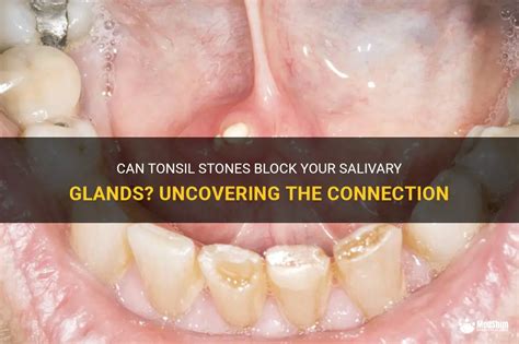 Can Tonsil Stones Block Your Salivary Glands Uncovering The Connection