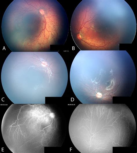 Case No 5 Aggressive Posterior Retinopathy Of Prematurity Posterior