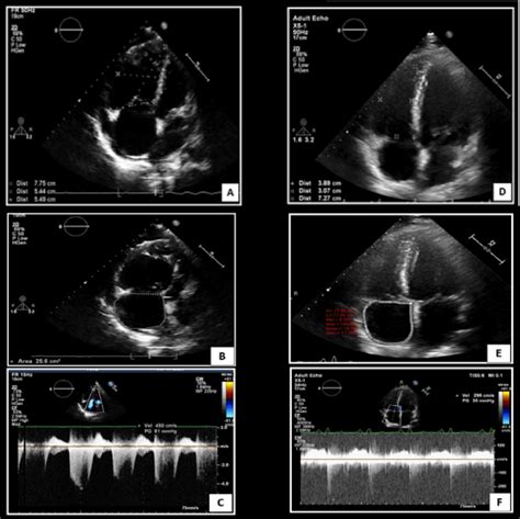 Transthoracic Echocardiography Apical 4 Chamber View Comparing