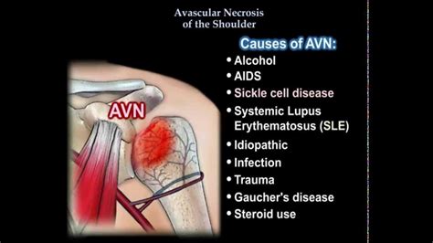 Avn Of The Shoulder Everything You Need To Know Dr Nabil Ebraheim Youtube