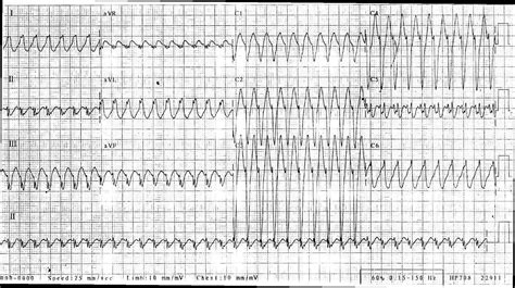 Instructors Collection Ecg Wide Complex Tachycardia All Content On The Ecg Guru Website Is