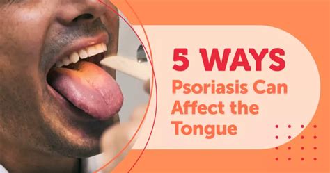 5 Ways Psoriasis Can Affect the Tongue | MyPsoriasisTeam