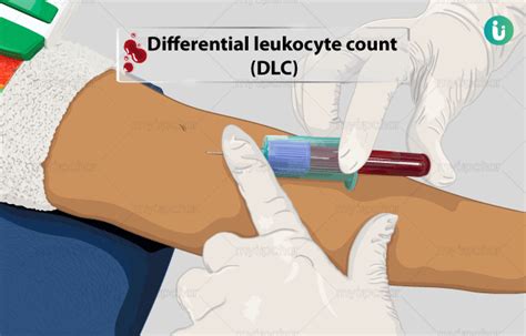 DLC Differential Leukocyte Count Procedure Purpose Results Normal