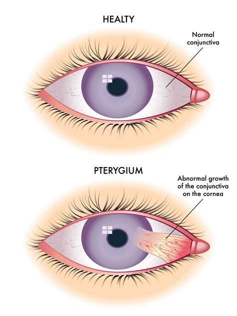 Pterygium Specialists Surfers Eye Long Beach Socal Eye