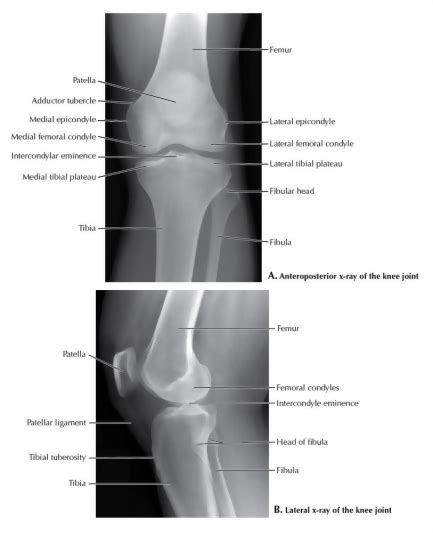 Knee X Ray Labeled