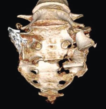 A Axial Head Ct Scan Indicating Hyperdense Fluid In The Lateral