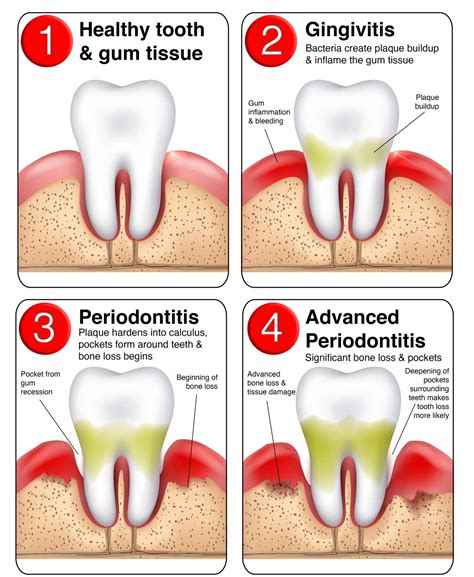 Understanding Gum Disease Causes Symptoms And Treatment Oralgos