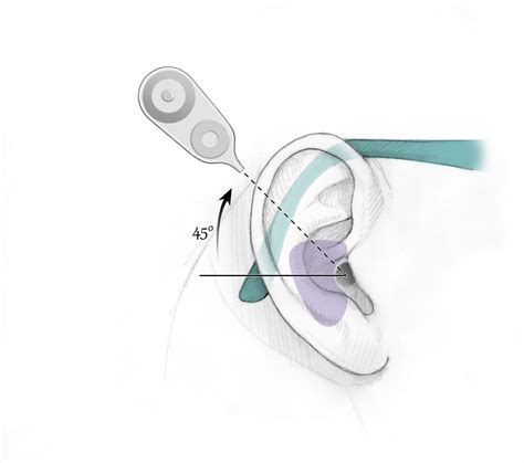 Cochlear Implant Surgery Oto Surgery Atlas