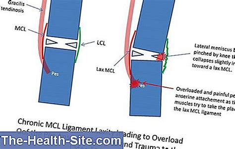 Internal Ligament Tear Causes Symptoms Treatment Prognosis 💊