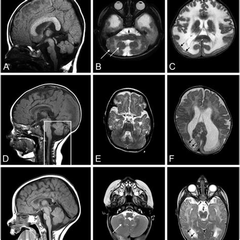 Pdf Cobblestone Malformation In Lama Congenital Muscular Dystrophy