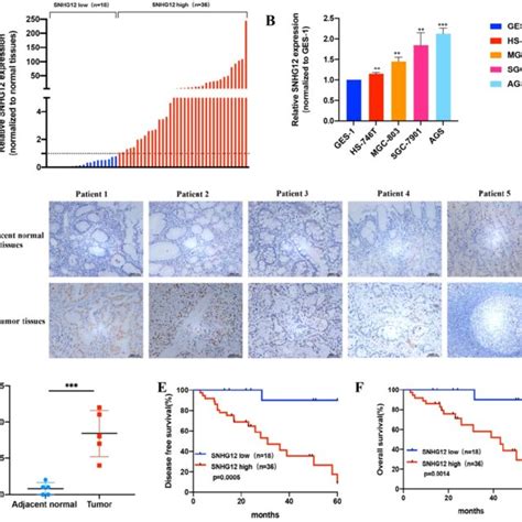 Snhg Is Overexpressed In Gc Tissues And Cell Lines And Indicates Poor