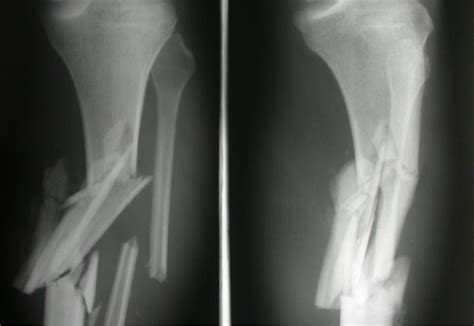 overview   types  fractures survivalkitcom