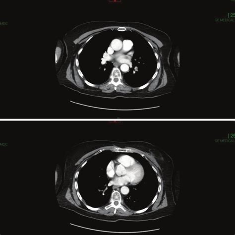 Pdf Thrombolysis Followed By Apixaban For Massive Pulmonary Embolism And Free Floating