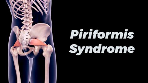 5 Effective Remedies for Piriformis Syndrome | Get Fit Owasso