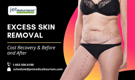 Excess Skin Removal Surgery Cost Recovery And Before And After