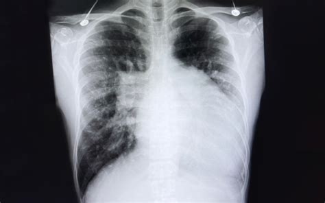 Understanding Edema with Heart Failure: Symptoms and Treatment