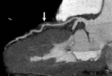 Role Of Coronary Ct Angiography In Spontaneous Coronary Artery