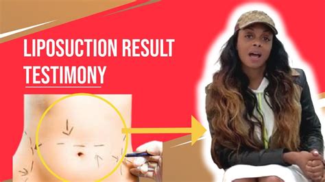 Liposuction Result Testimony Youtube