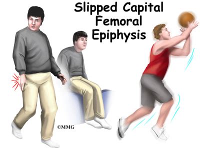 Slipped Capital Femoral Epiphysis - eOrthopod.com